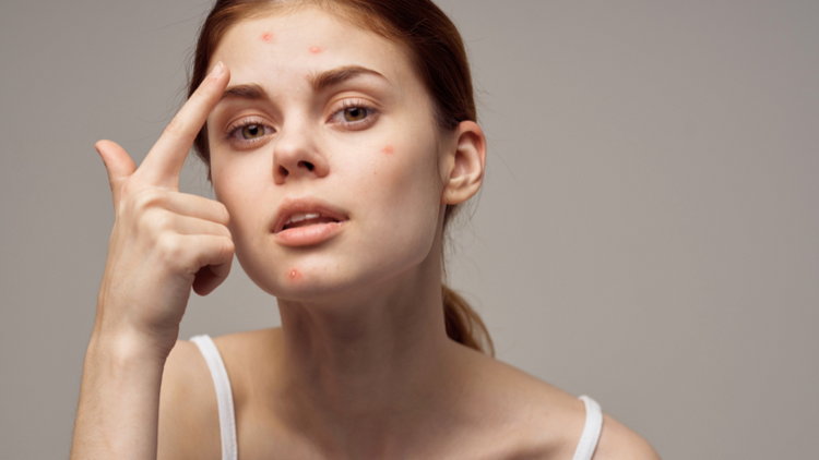 ACNE-PRONE / OILY SKIN