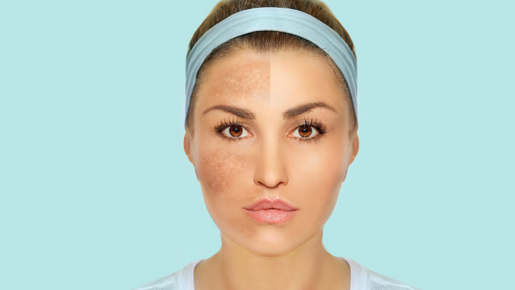 PIGMENTATION / MELASMA