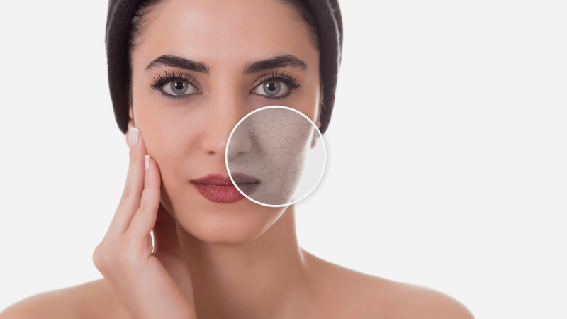 DRY SKIN