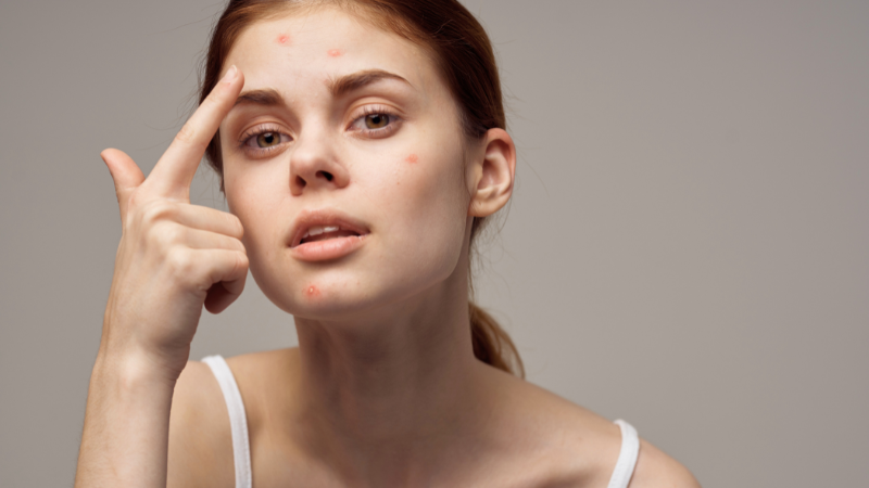 ACNE-PRONE / OILY SKIN